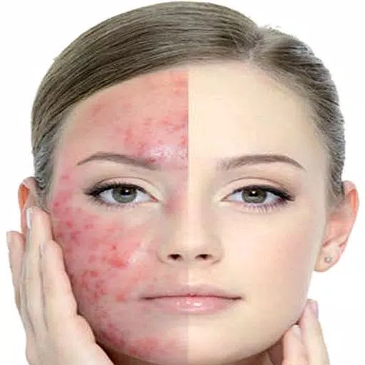 Schermata Get Rid of Acne  (Guide) 2